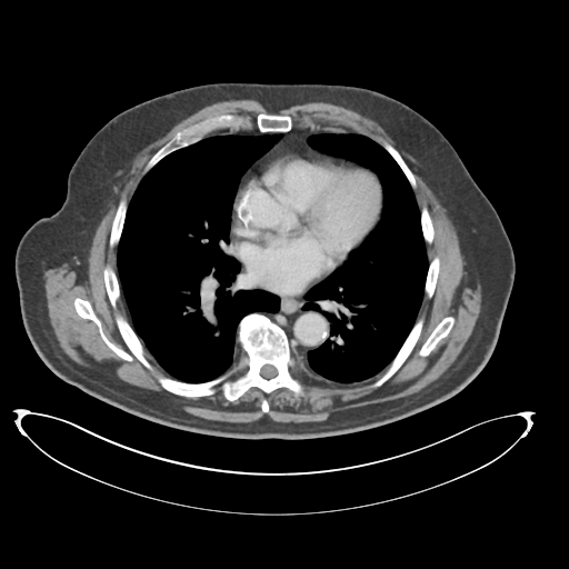 Adenocarcioma of rectum- T1 lesion (Radiopaedia 36921-38547 Axial C+ portal venous phase 1).png