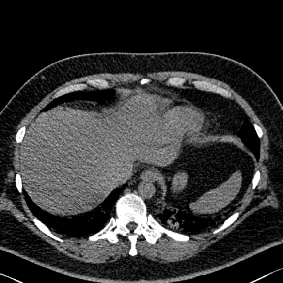 Adenoid cystic carcinoma of the trachea (Radiopaedia 49042-54137 Axial non-contrast 287).jpg
