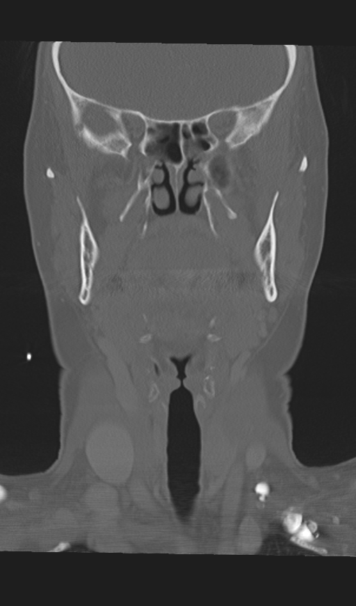 Adenoid cystic tumor of palate (Radiopaedia 46980-51518 Coronal bone window 29).png