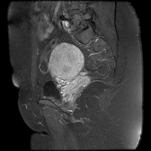 File:Adenomyosis-scar endometriosis (Radiopaedia 65863-75022 Sagittal T1 C+ fat sat 18).jpg