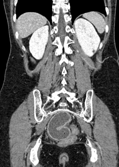 Adhesional small bowel obstruction (Radiopaedia 48397-53305 Coronal C+ portal venous phase 272).jpg