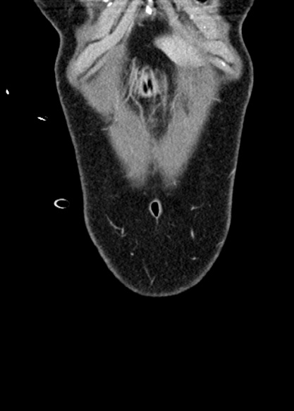 Adhesional small bowel obstruction (Radiopaedia 48397-53305 Coronal C+ portal venous phase 33).jpg