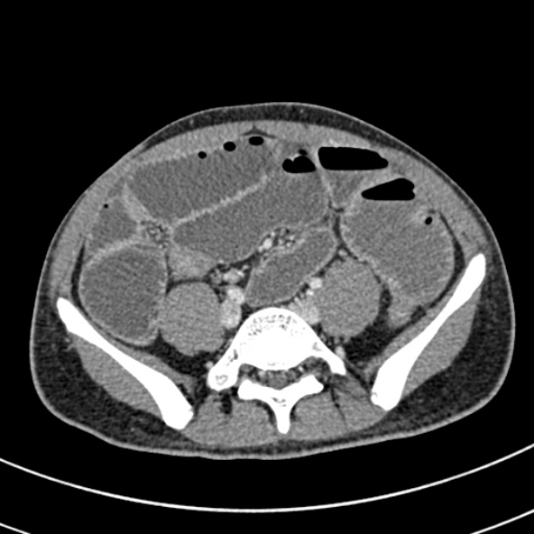 Adhesional small bowel obstruction (Radiopaedia 52107-57980 Axial C+ portal venous phase 86).jpg