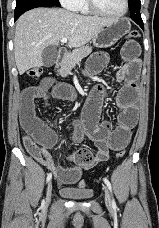 Adhesional small bowel obstruction (Radiopaedia 58900-66131 Coronal C+ portal venous phase 117).jpg