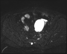 File:Adnexal multilocular cyst (O-RADS US 3- O-RADS MRI 3) (Radiopaedia 87426-103754 Axial DWI 8).jpg