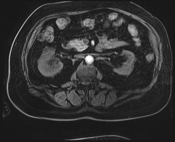 Adrenal cortical carcinoma (Radiopaedia 64017-72770 H 23).jpg
