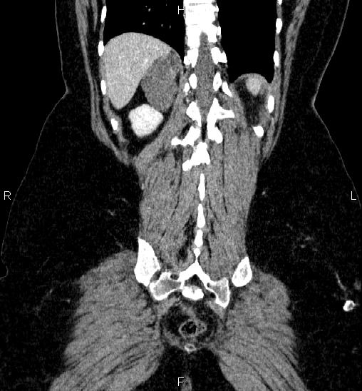 Adrenal cortical carcinoma (Radiopaedia 84882-100379 Coronal C+ portal venous phase 54).jpg