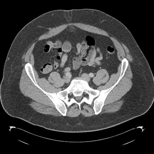 Adrenal cyst (Radiopaedia 45625-49776 Axial C+ portal venous phase 71).png