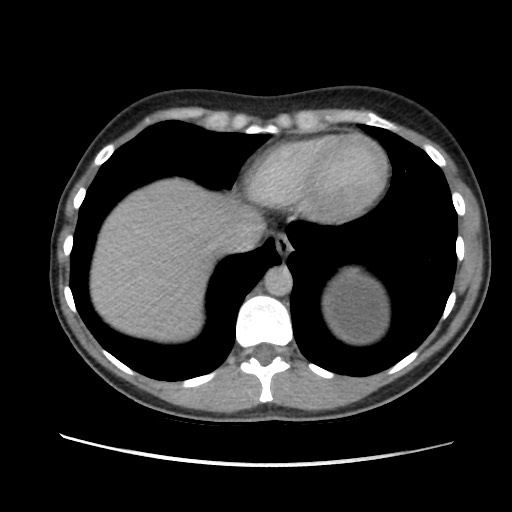 Adrenal cyst (Radiopaedia 64869-73813 Axial C+ portal venous phase 11).jpg