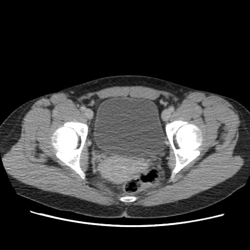 Adrenal cyst (Radiopaedia 64869-73813 Axial C+ portal venous phase 74).jpg