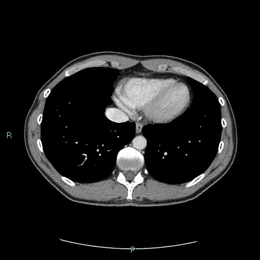 Adrenal cystic lymphangioma (Radiopaedia 83161-97534 Axial C+ portal venous phase 8).jpg