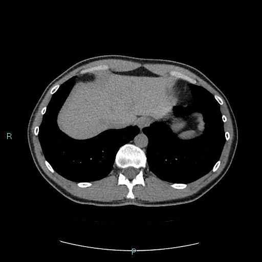 Adrenal cystic lymphangioma (Radiopaedia 83161-97534 Axial non-contrast 16).jpg