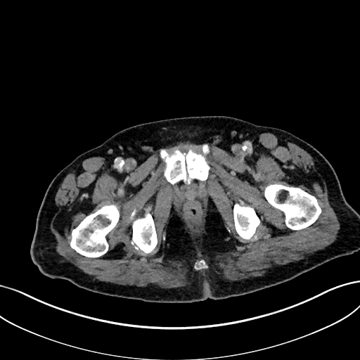 File:Adrenal lymphoma (Radiopaedia 73730-84529 Axial C+ portal venous phase 129).jpg