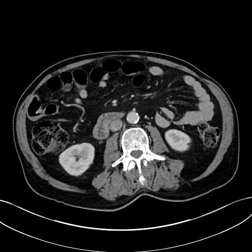 Adrenal lymphoma (Radiopaedia 73730-84529 Axial C+ portal venous phase 61).jpg