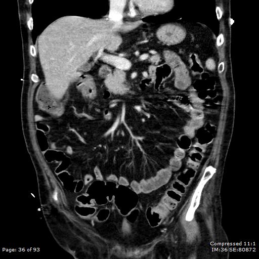 File:Adrenal metastasis (Radiopaedia 78425-91079 Sagittal C+ portal venous phase 23).jpg