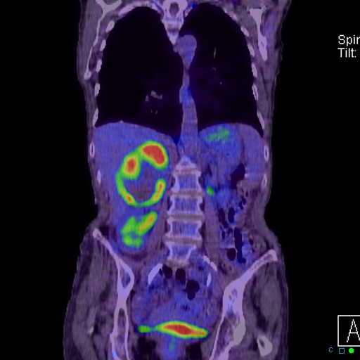 File:Adrenal metastasis from small cell lung cancer (Radiopaedia 19133-19109 Coronal 18).jpg