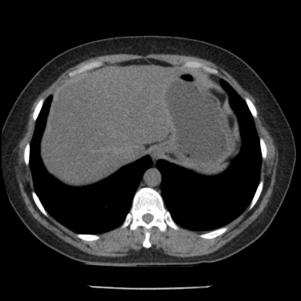 Adrenal myelolipoma (Radiopaedia 43401-46759 Axial non-contrast 12).jpg
