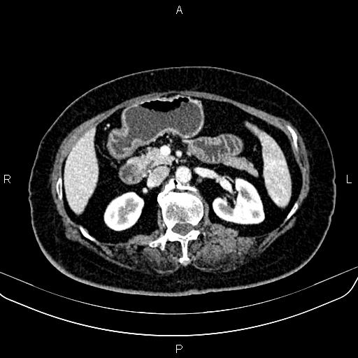 Adrenal myelolipoma (Radiopaedia 82742-96986 Axial renal cortical phase 69).jpg
