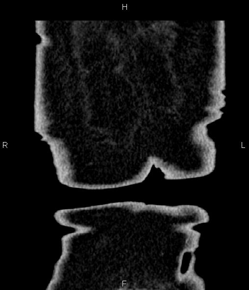 Adrenal myelolipoma (Radiopaedia 82742-96986 Coronal renal cortical phase 78).jpg