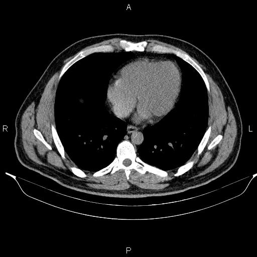 Adrenal myelolipoma (Radiopaedia 84321-99619 Axial non-contrast 8).jpg
