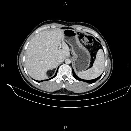 Adrenal myelolipoma (Radiopaedia 87794-104246 Axial renal cortical phase 22).jpg