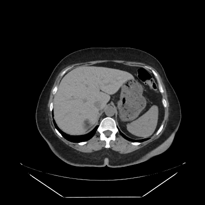 Adrenal myelolipoma - MRI (Radiopaedia 83249-97647 Axial non-contrast 2).jpg