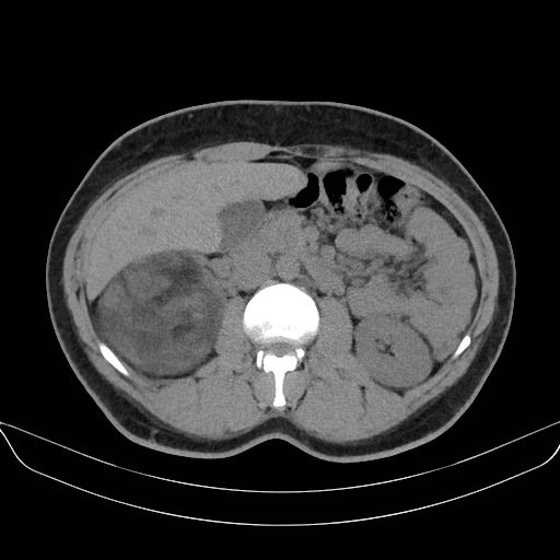 Adrenal myelolipoma - bilateral (Radiopaedia 74805-85810 Axial non-contrast 32).jpg