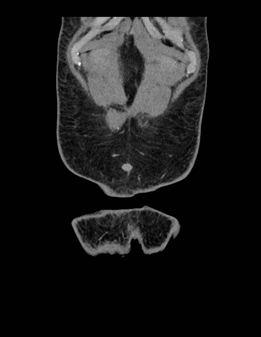 Adrenal myelolipoma - bilateral (Radiopaedia 74805-85810 Coronal C+ portal venous phase 247).jpg