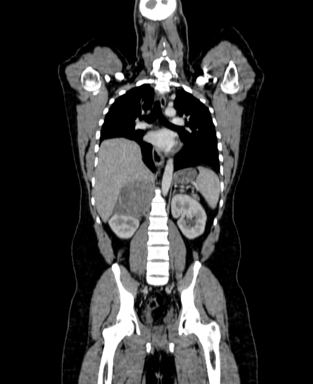Adrenocortical carcinoma (Radiopaedia 80134-93438 Coronal C+ portal venous phase 104).jpg