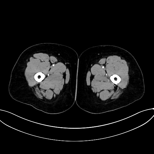 Adrenocortical carcinoma (Radiopaedia 87281-103569 Axial C+ arterial phase 106).jpg