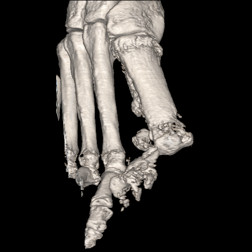 File:Advanced osteomyelitis due to open metatarsal fracture (Radiopaedia 83891-99095 VRT 11).jpg