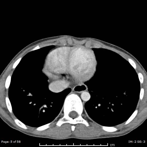 File:Agenesis of the gallbladder (Radiopaedia 55454-61905 B 5).jpg
