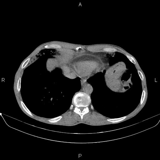 Air bronchogram in pneumonia (Radiopaedia 85719-101512 Axial non-contrast 54).jpg