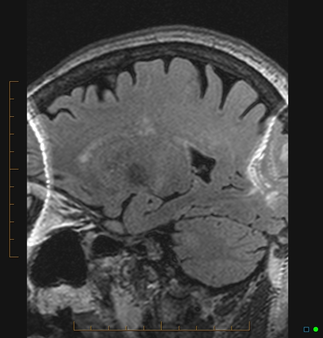 Aliasing artifact causing a spurious cerebellar lesion (Radiopaedia 48783-53810 Sagittal FLAIR 12).jpg