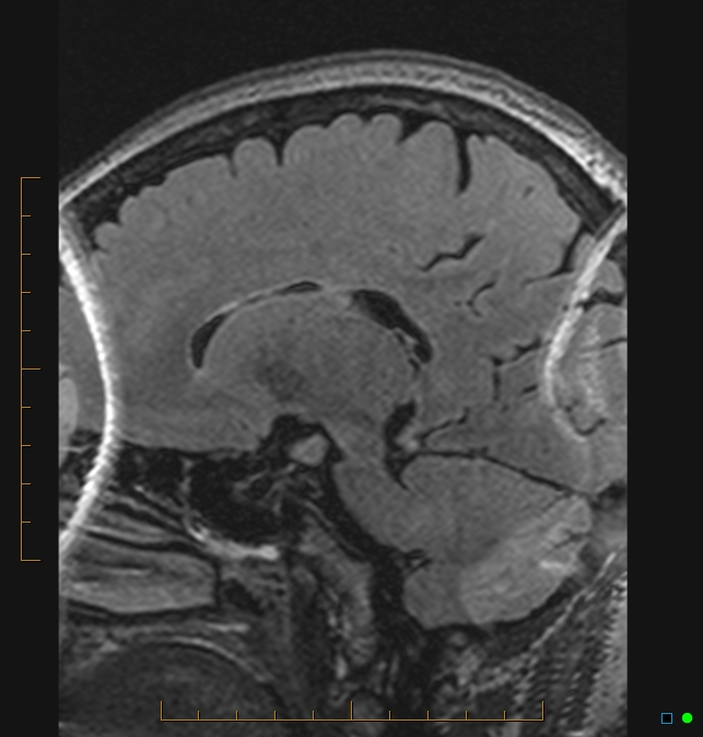 Aliasing artifact causing a spurious cerebellar lesion (Radiopaedia 48783-53810 Sagittal FLAIR 66).jpg