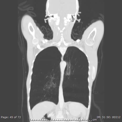 Alpha-1-antitrypsin deficiency (Radiopaedia 50561-55987 Coronal lung window 43).jpg