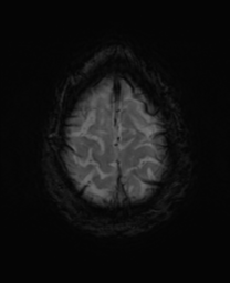 File:Alzheimer's disease- with Gerstmann syndrome and dressing apraxia (Radiopaedia 54882-61150 Axial SWI 32).png