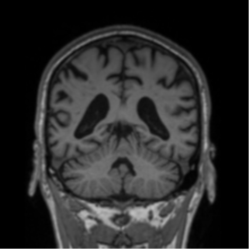 File:Alzheimer's disease- with Gerstmann syndrome and dressing apraxia (Radiopaedia 54882-61150 Coronal T1 31).png