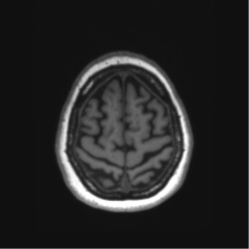 Alzheimer's disease (Radiopaedia 64586-73460 Axial T1 3).png