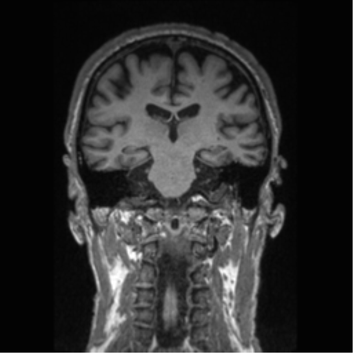 Alzheimer disease - probable (Radiopaedia 35334-36837 Coronal T1 41).png