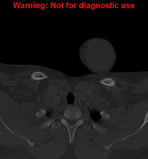 Ameloblastoma (Radiopaedia 33126-34164 Axial bone window 46).jpg