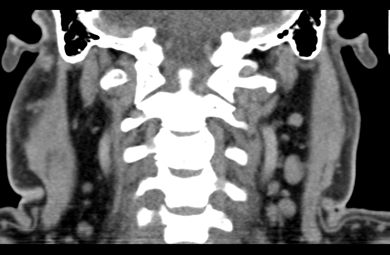 Ameloblastoma (Radiopaedia 33677-34806 Coronal non-contrast 49).png