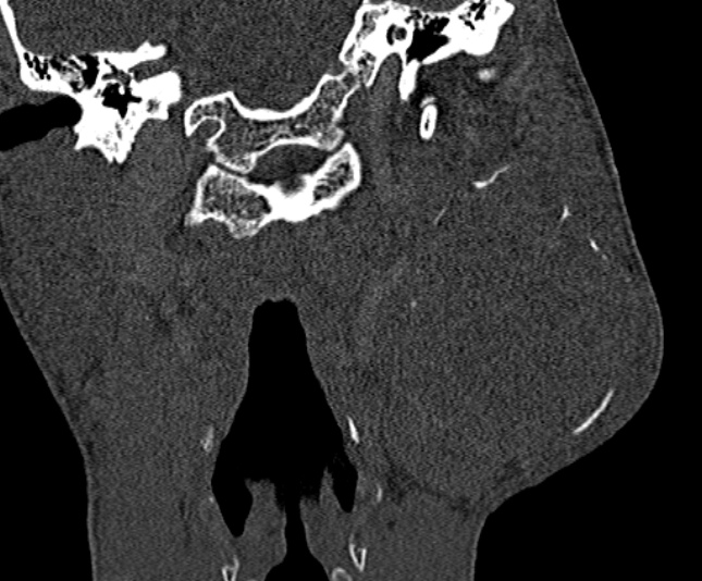 Ameloblastoma (Radiopaedia 51921-57766 Coronal bone window 200).jpg