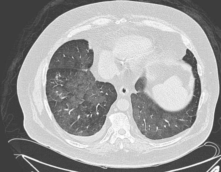 Amiodarone lung (Radiopaedia 62514-70769 Axial lung window 67).jpg