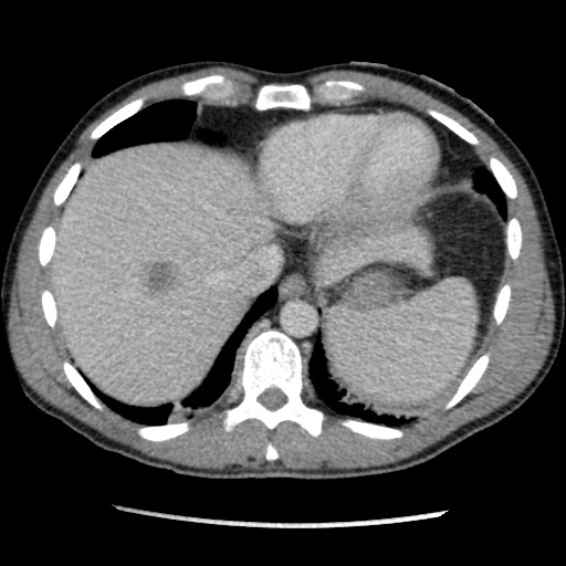 Amoebic liver abscesses (Radiopaedia 55536-62009 A 13).jpg