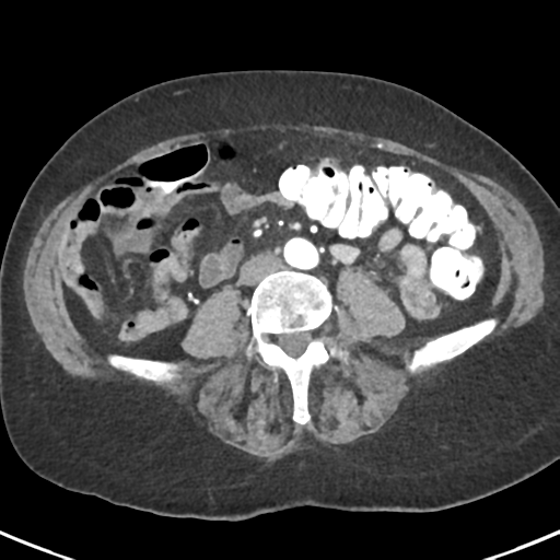 Ampullary adenocarcinoma (Radiopaedia 34013-35237 B 60).png