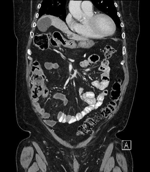 Ampullary adenocarcinoma (Radiopaedia 59373-66734 D 26).jpg