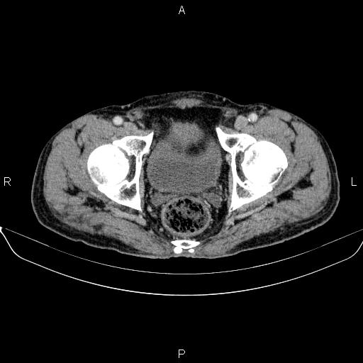 Ampullary adenocarcinoma (Radiopaedia 86093-102032 A 53).jpg