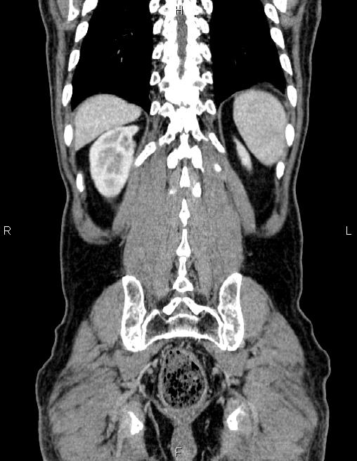 Ampullary adenocarcinoma (Radiopaedia 86093-102032 C 57).jpg