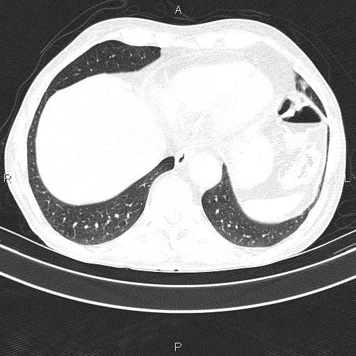 Ampullary adenocarcinoma (Radiopaedia 86093-102033 Axial lung window 47).jpg